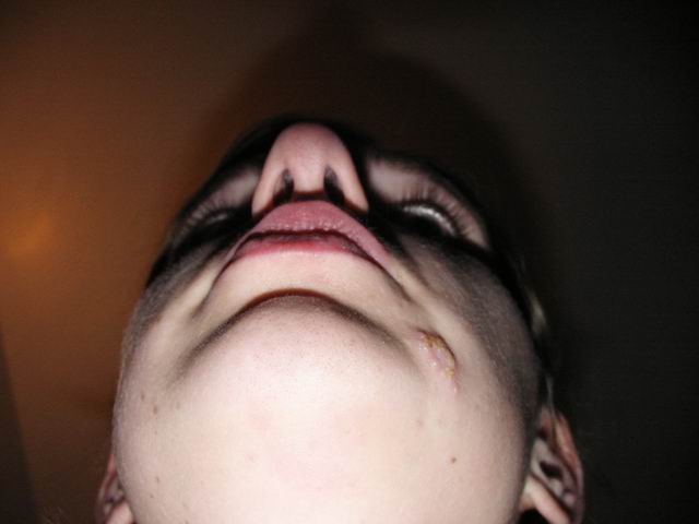 Herpes simplex, typ 1